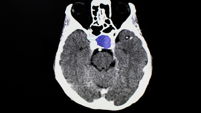CT scan of the brain showing a pituitary tumor.